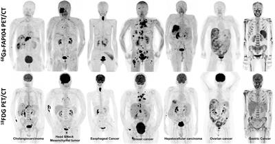 Fibroblast-Activated Protein Inhibitor PET/CT: Cancer Diagnosis and Management